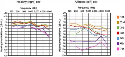 Repeated sudden sensorineural hearing loss with intralabyrinthine hemorrhage in a patient with Glanzmann thrombasthenia: case report